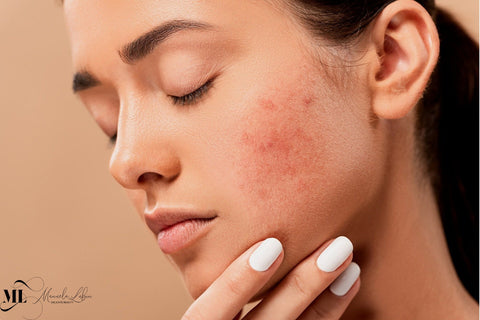 woman’s cheek with visible acne scars - ML Delicate Beauty