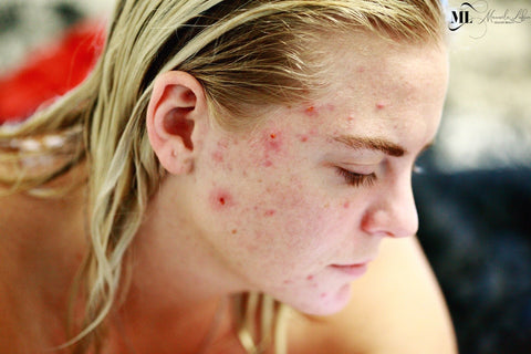 Woman with severe acne on her face - ML Delicate Beauty