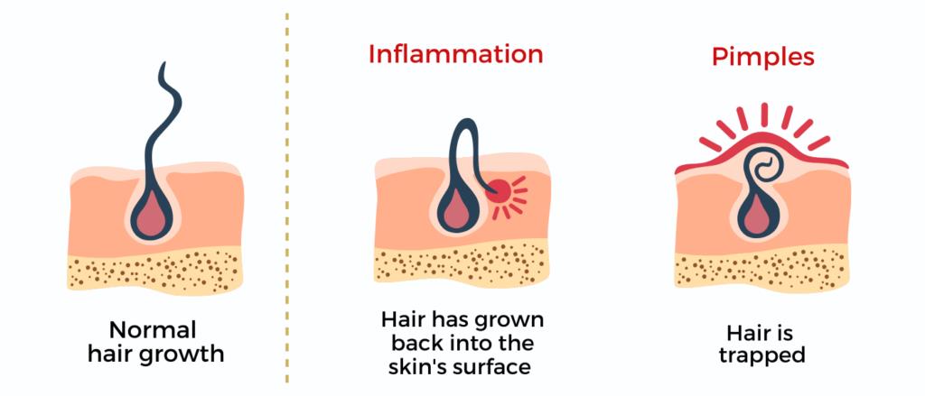 Preventing Ingrown Hairs: The Role of Laser Hair Removal