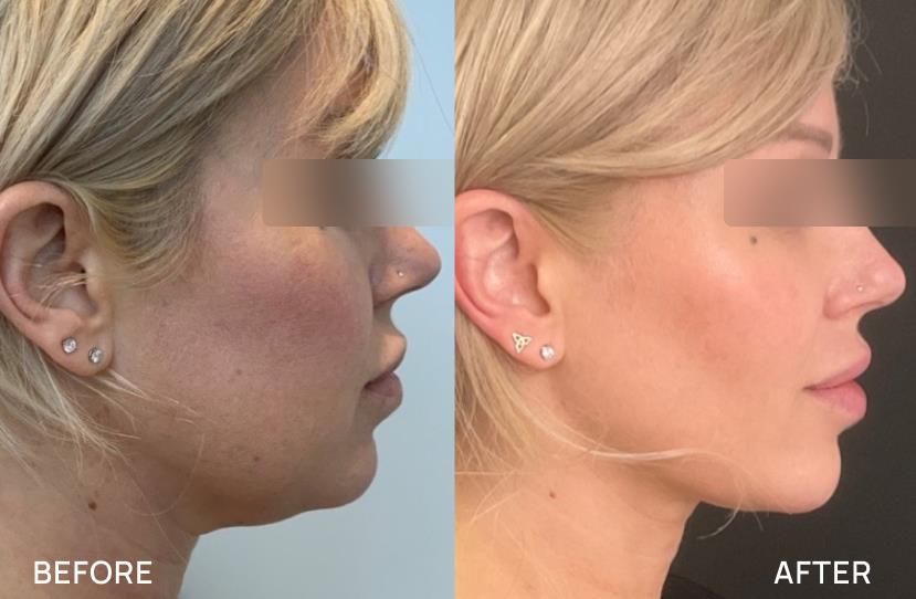 5 benefits of Silhouette Instalift®: A non-surgical approach to facial rejuvenation