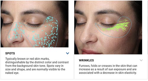 Canfield Visia Skin Complexion Analysis and Facial Imaging