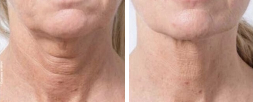 profhilo before and after - bioremodeling in melbourne